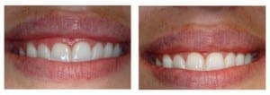 Cosmetic Crown Lengthening