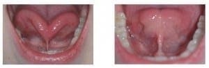 Pre and Post Operative Comparison