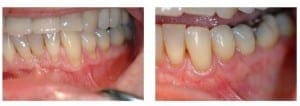 Pre and Post Operative Comparison