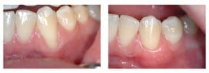 Sub epithelial Connective Tissue Graft of the lower left canin