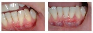 Sub epithelial Connective Tissue Graft of the lower left incisor