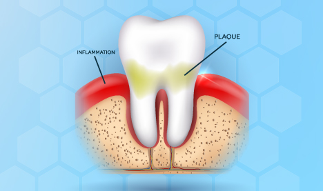 Gingivitis-mild