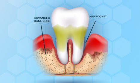 3D rendering showing advanced periodontal disease