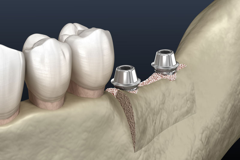 3D rendering of a Ridge Augmentation procedure