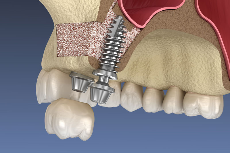 3D rendering of a Sinus lift with implants