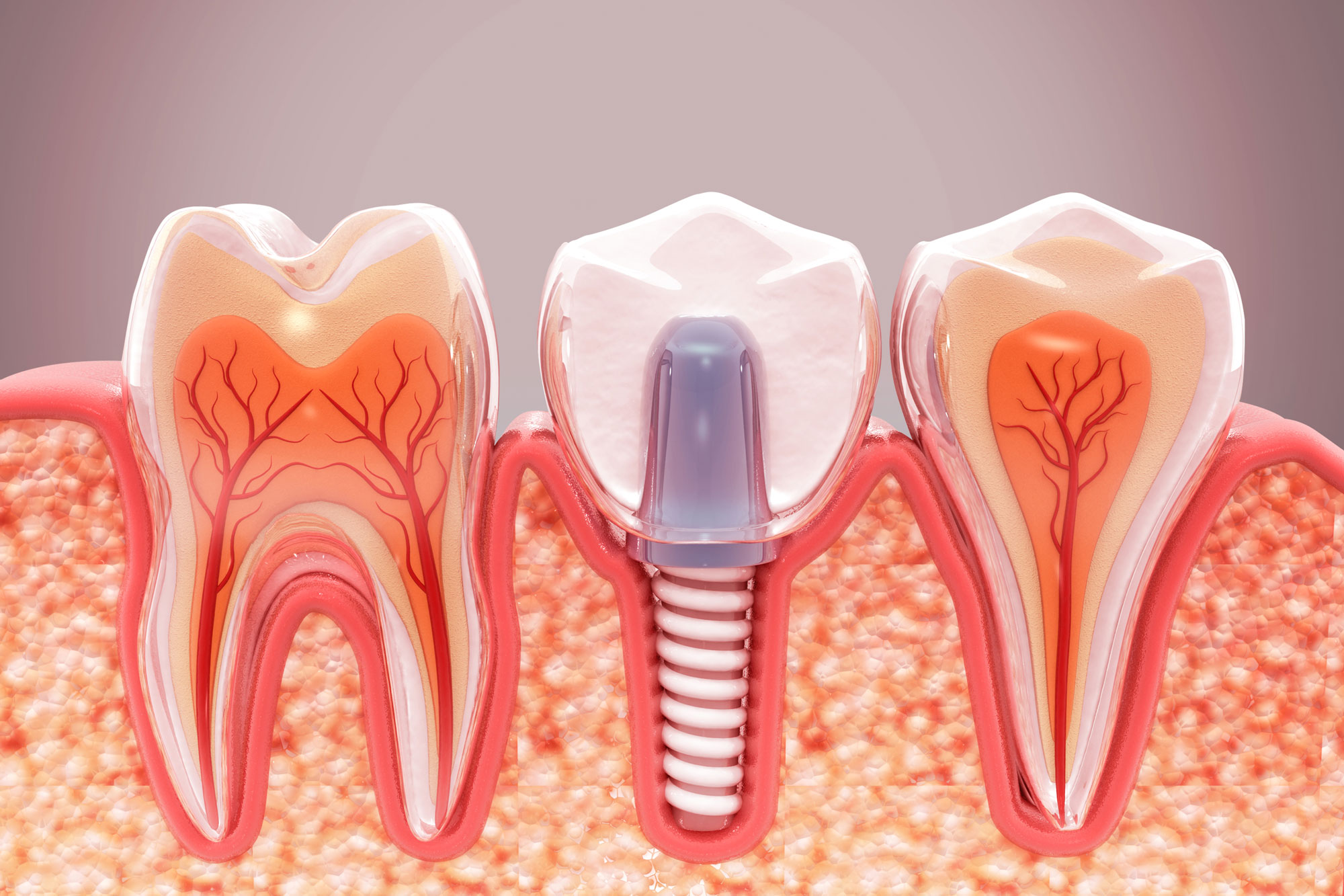 3D Rendering of a dental implant