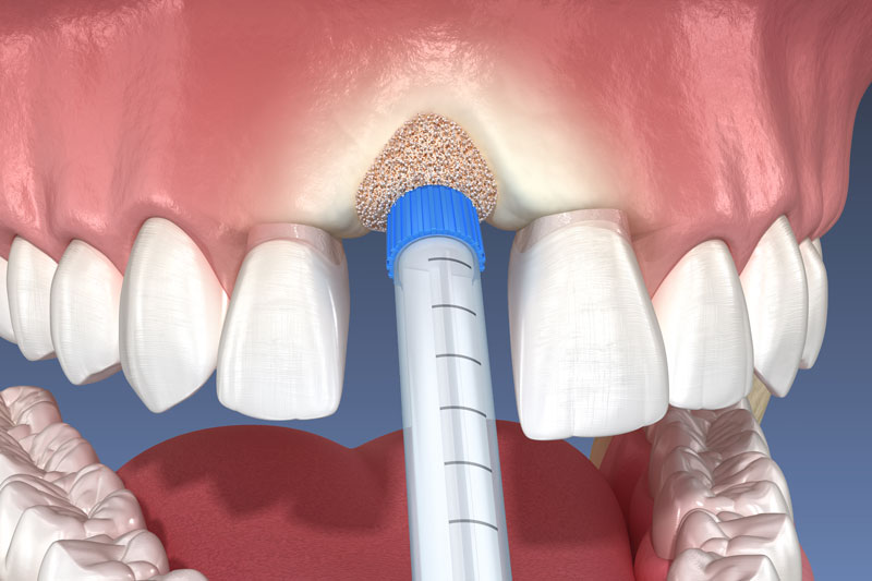 3D Rendering of a socket preservation being performed