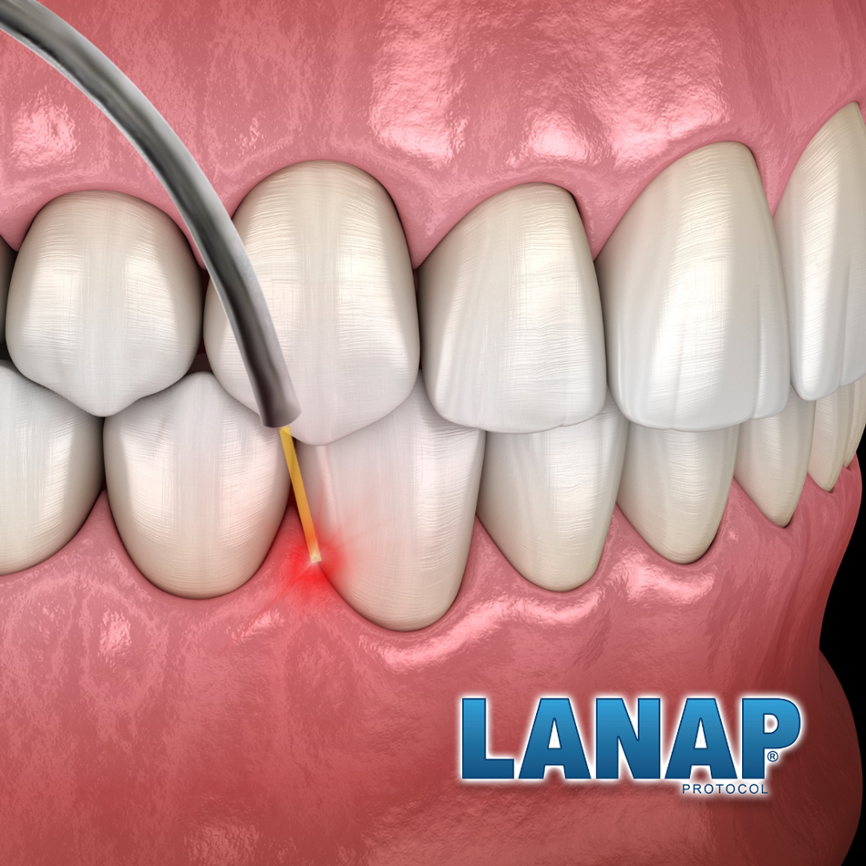 Diagram of the LANAP Protocol being done