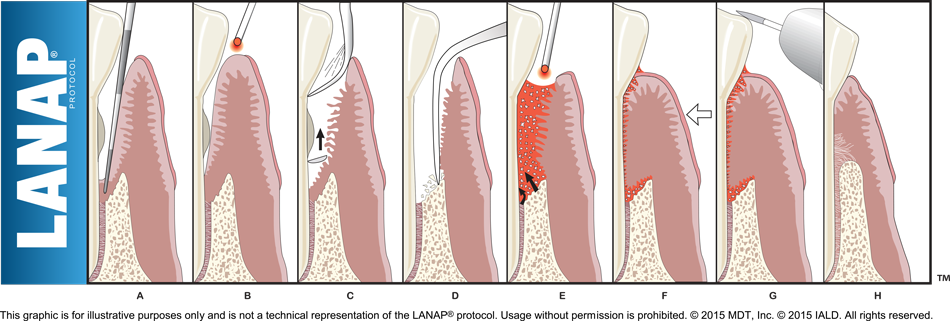 Diagram of LANAP Protocol's steps