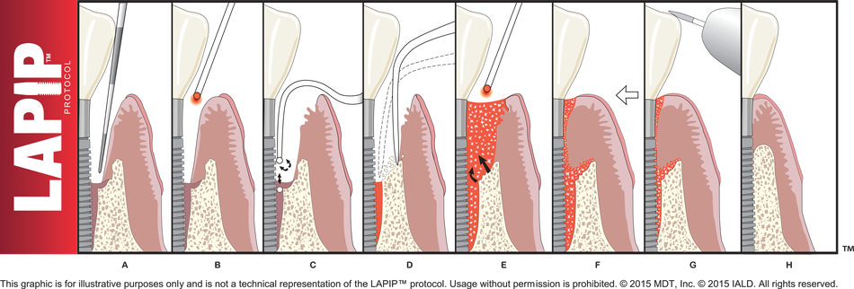 Diagram of LAPIP Protocol steps