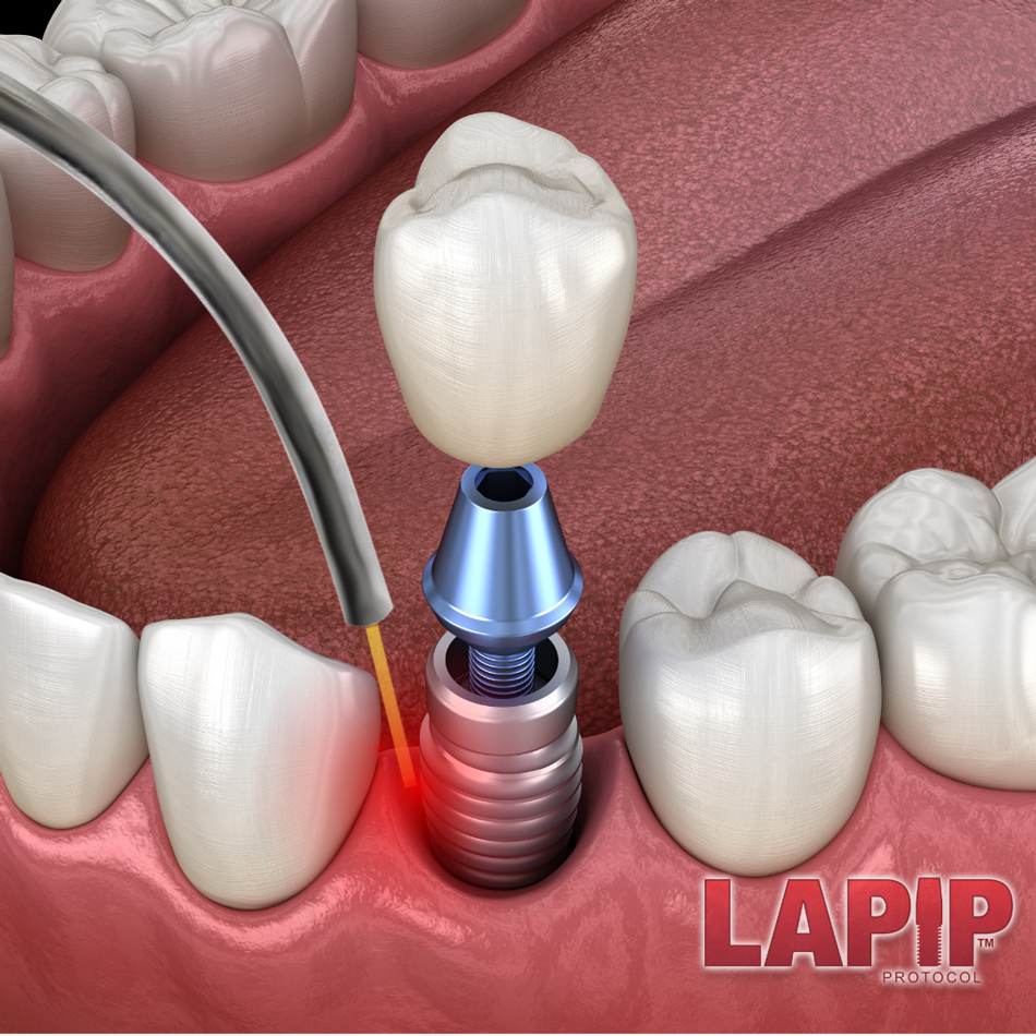 Diagram of LAPIP Protocol being done on an implant